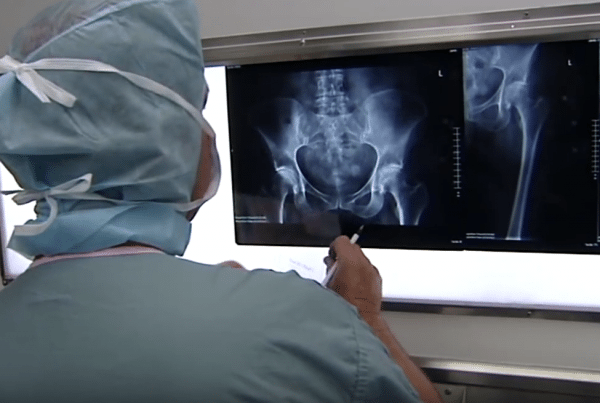 Total Hip Arthroplasty Hip & Thigh Replacement