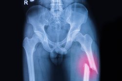 Thigh Fracture Image of Open Fracture