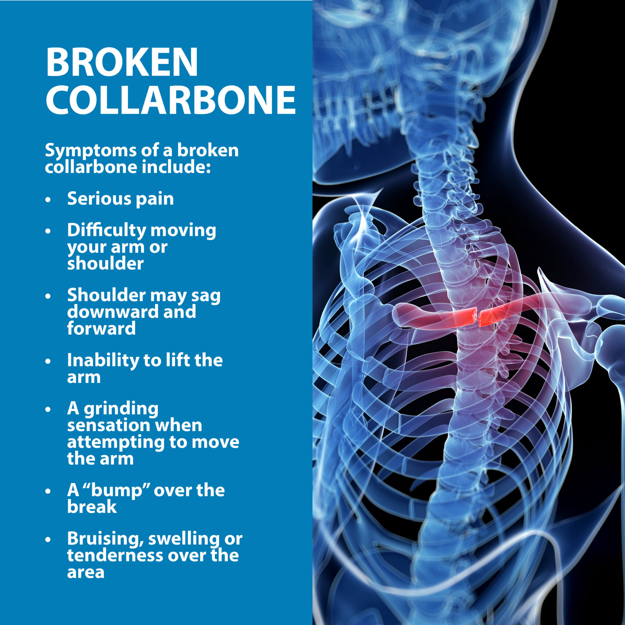 Broken Collarbone Florida Orthopaedic Institute