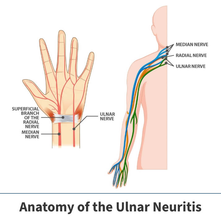 Ulnar Neuritis Anatomy