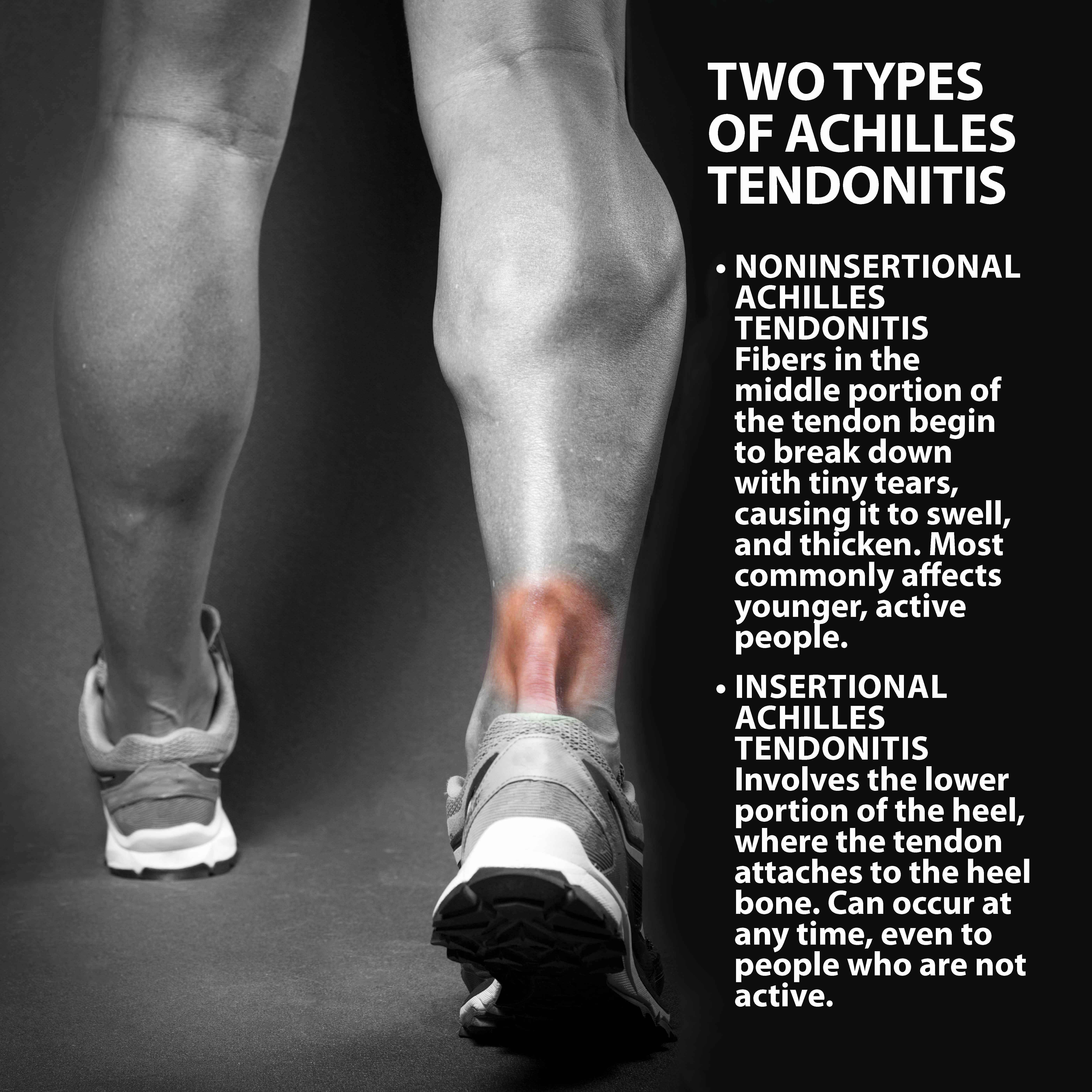 Types of Achilles Tendonitis graph