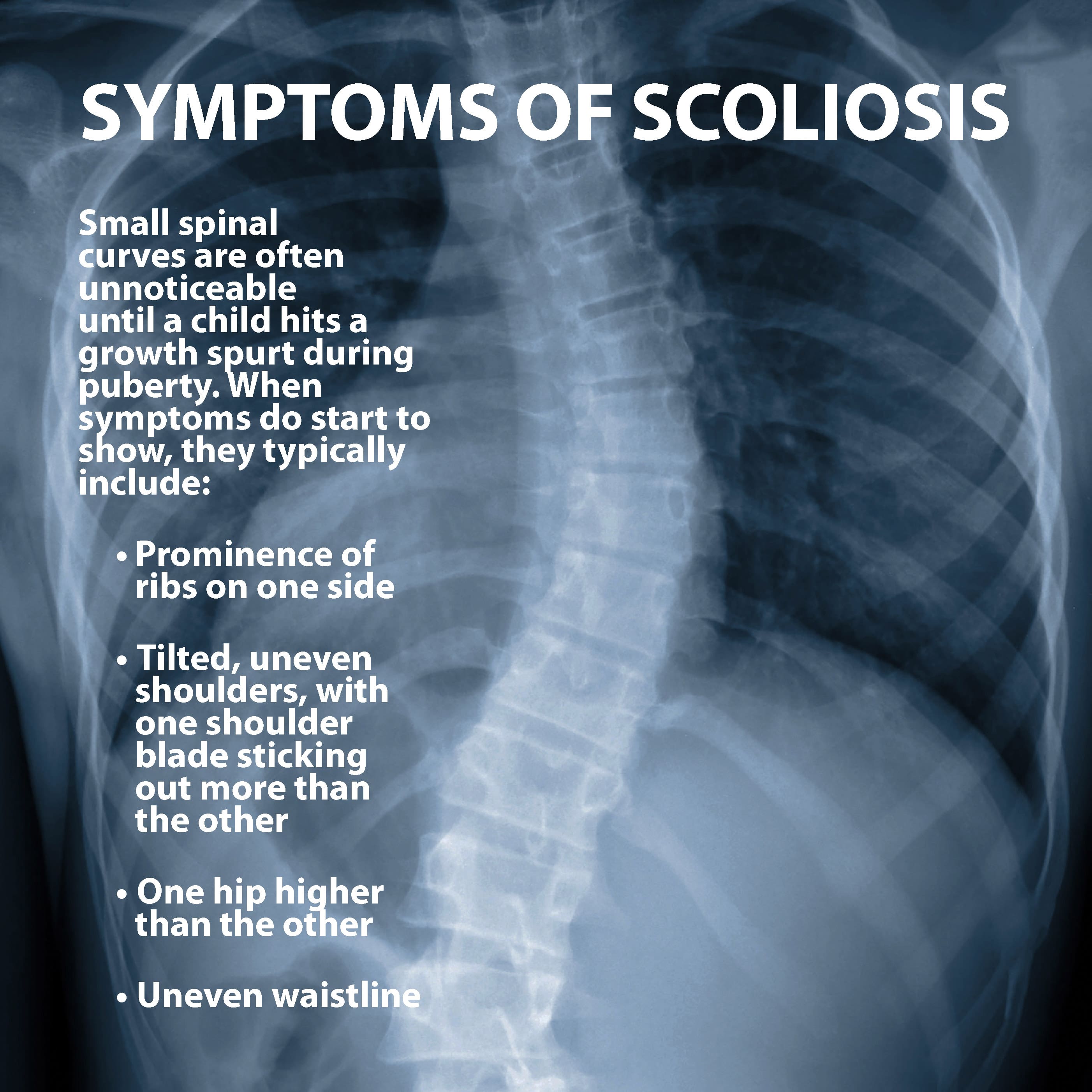 Symptoms of Scoliosis Graphic