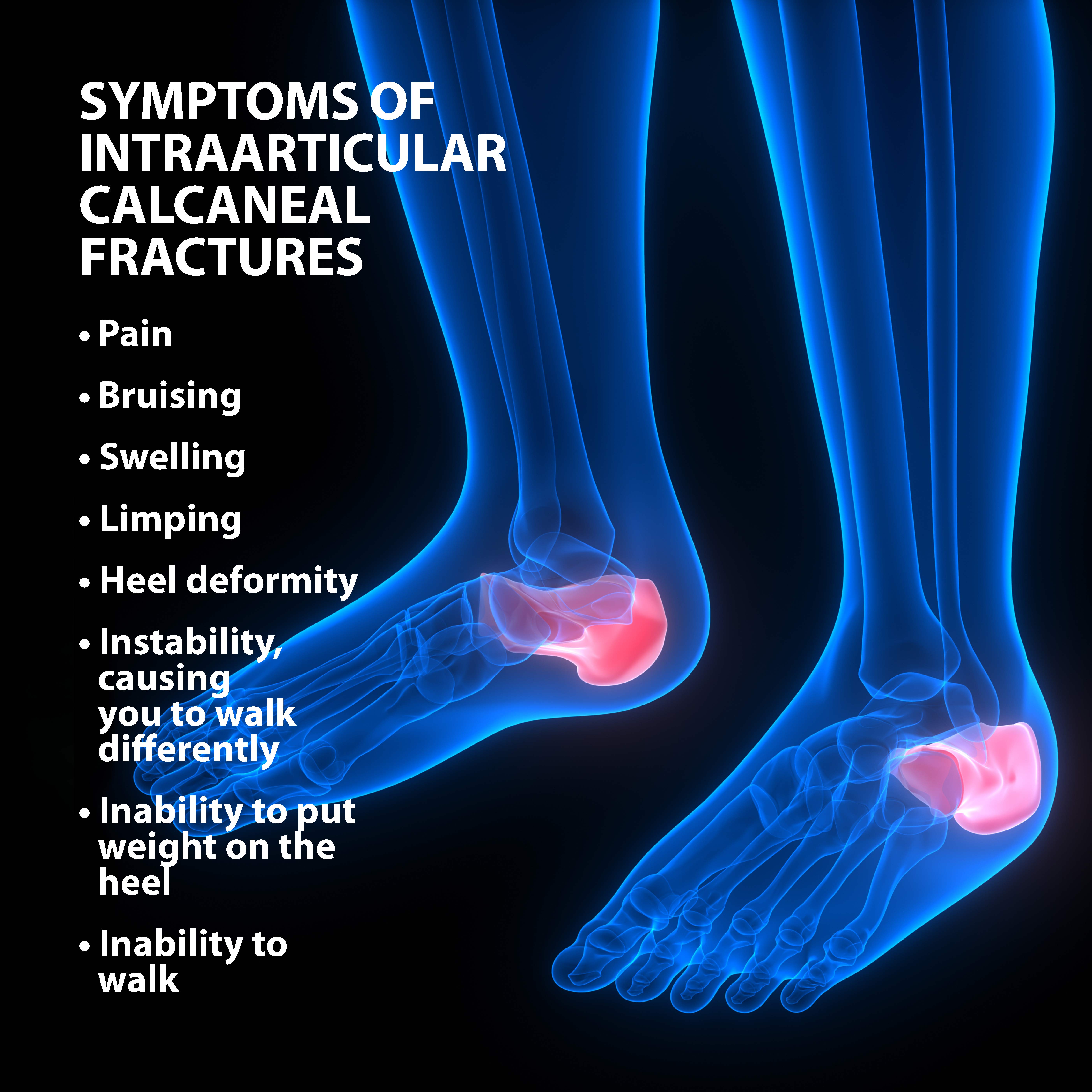 Shattered Calcaneus (heel bone)