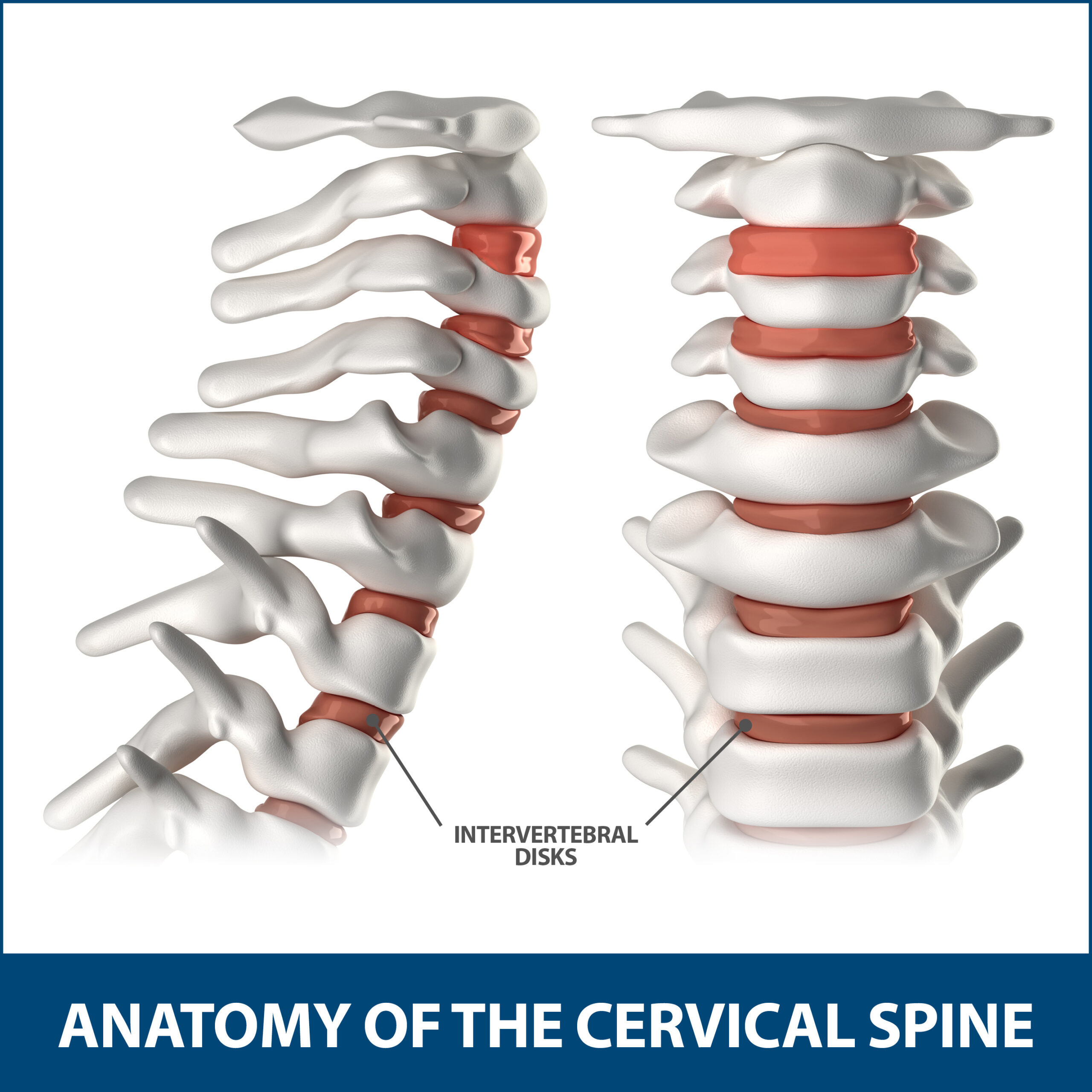 What to Do About a Pinched Nerve in the Neck - AICA Orthopedics