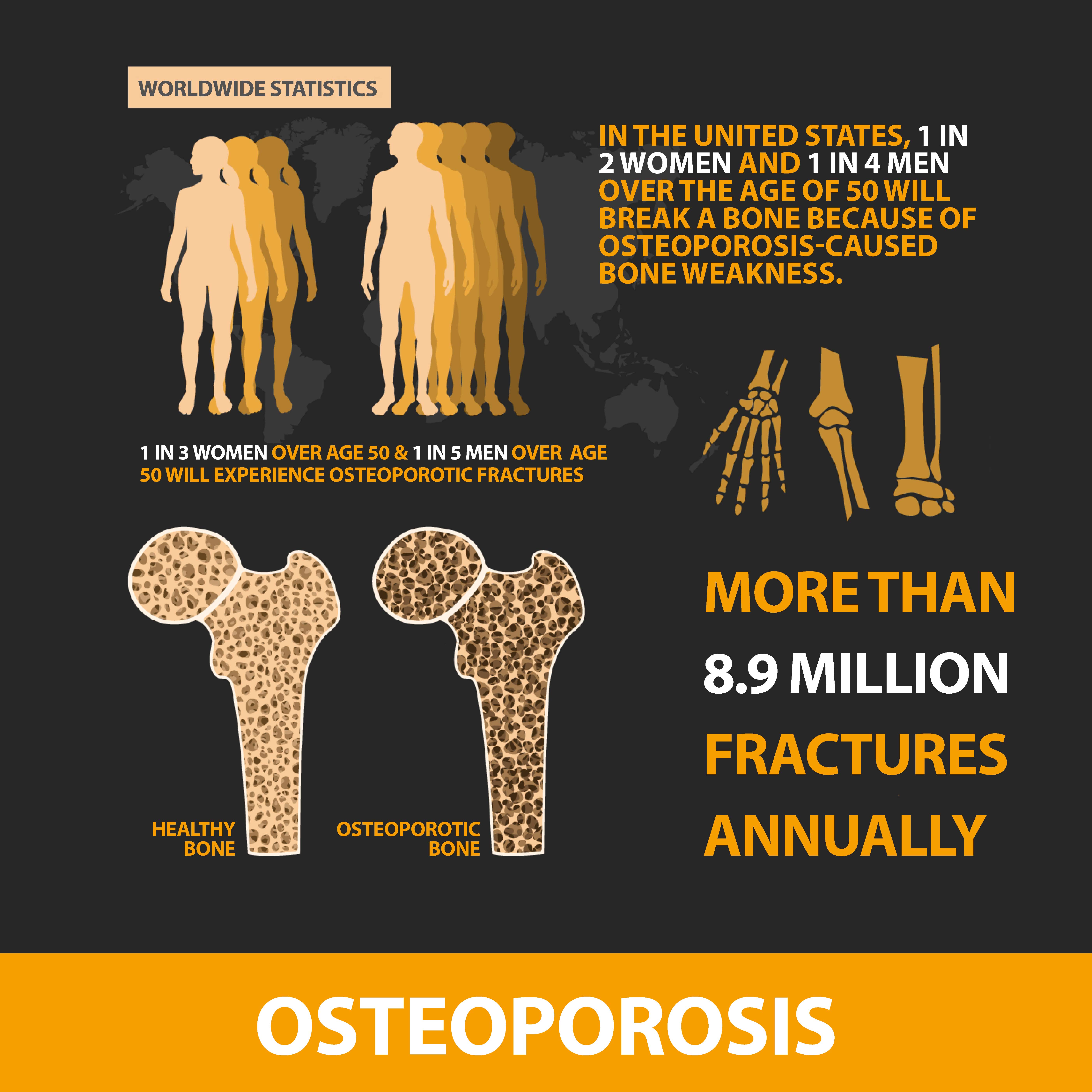Osteoporosis graphic