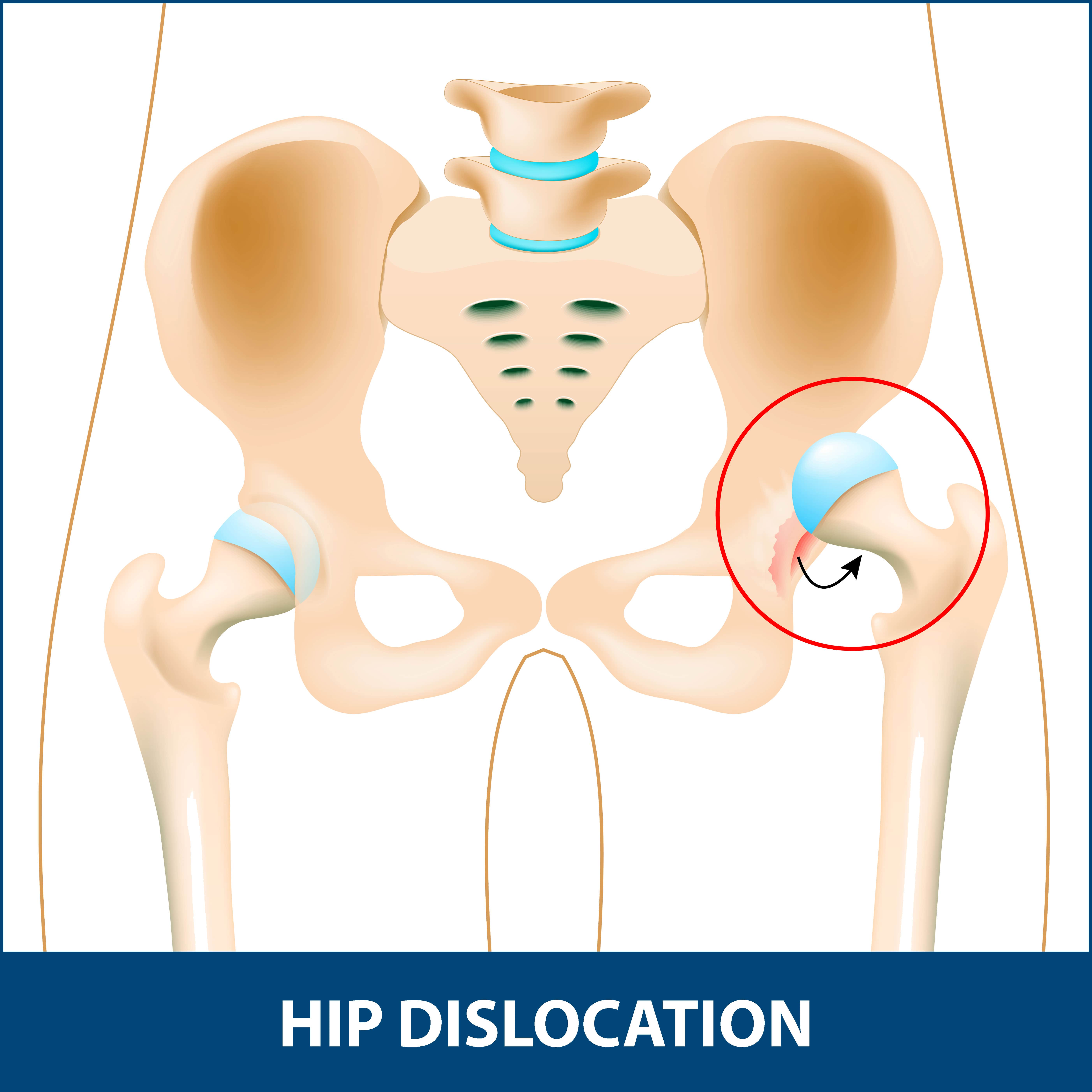 hip dislocation graphic