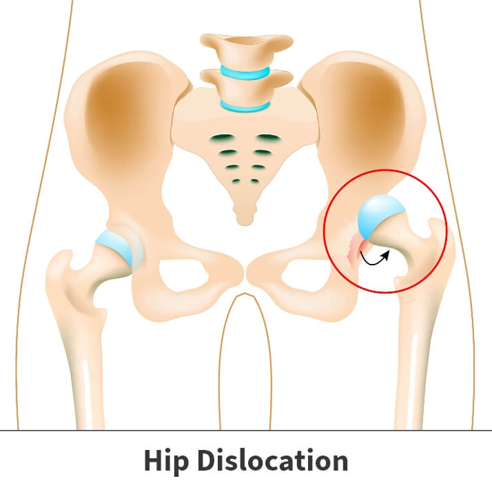 hip displacement