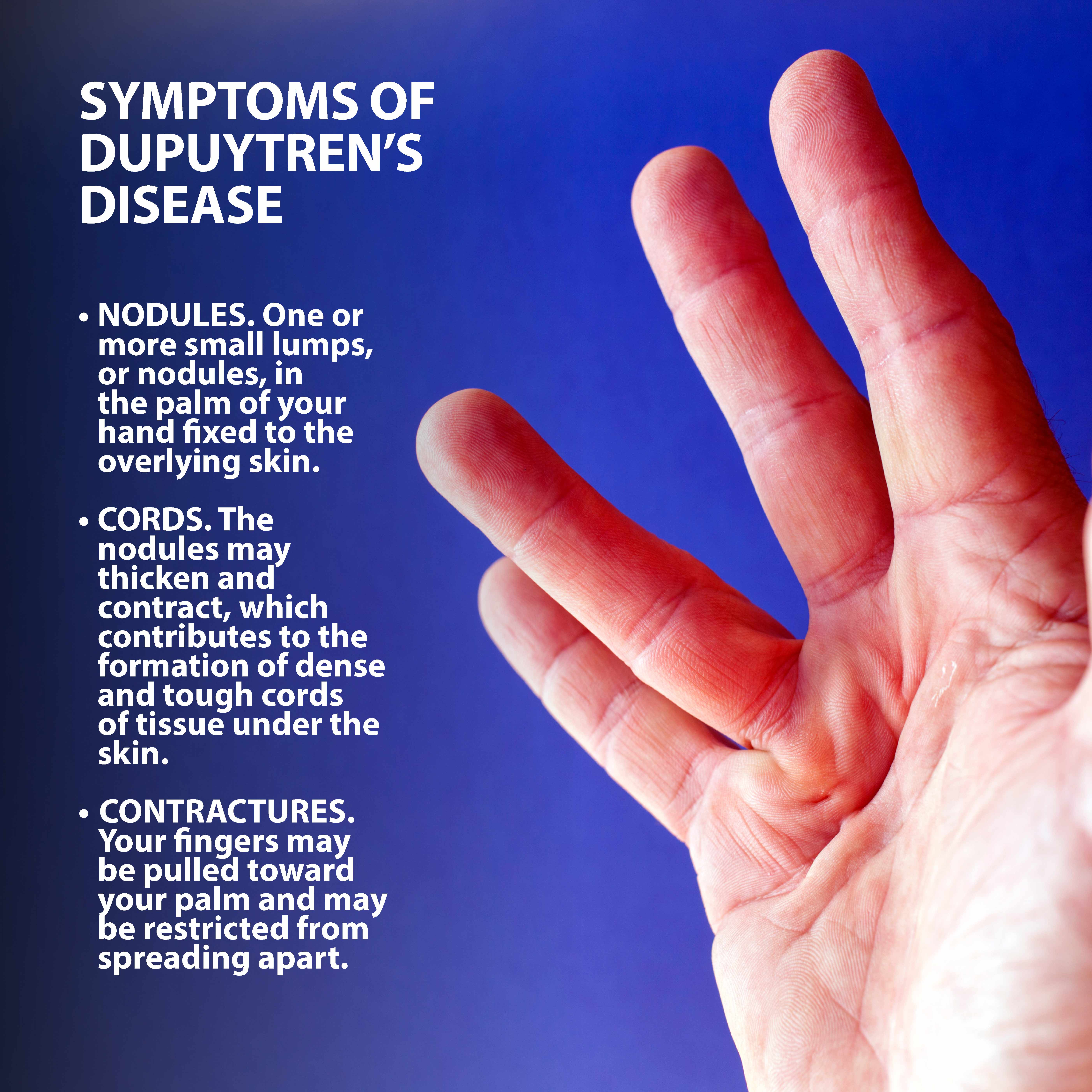 Dupuytren’s Disease Symptoms Graphic