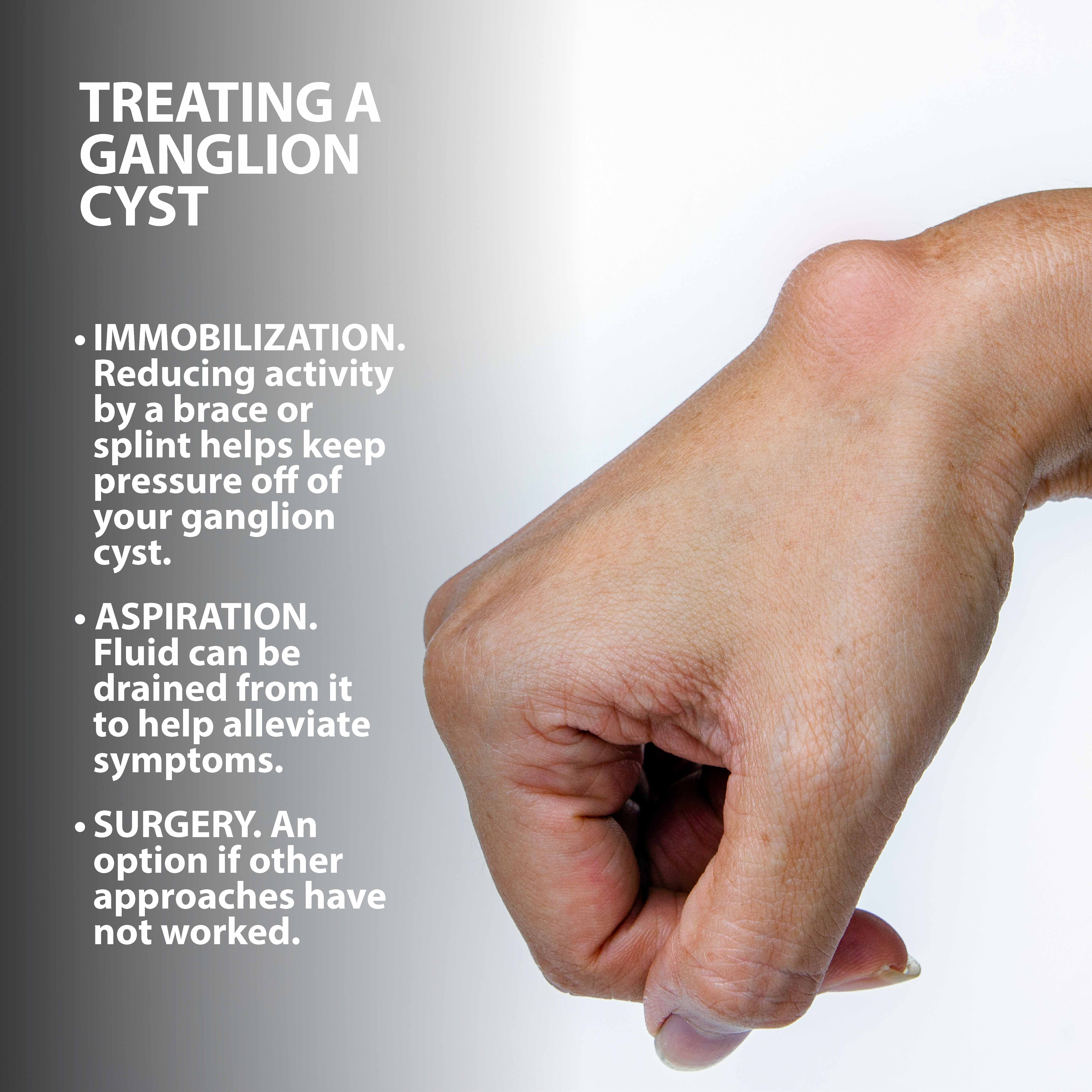 Ganglion Cysts treatment graphic