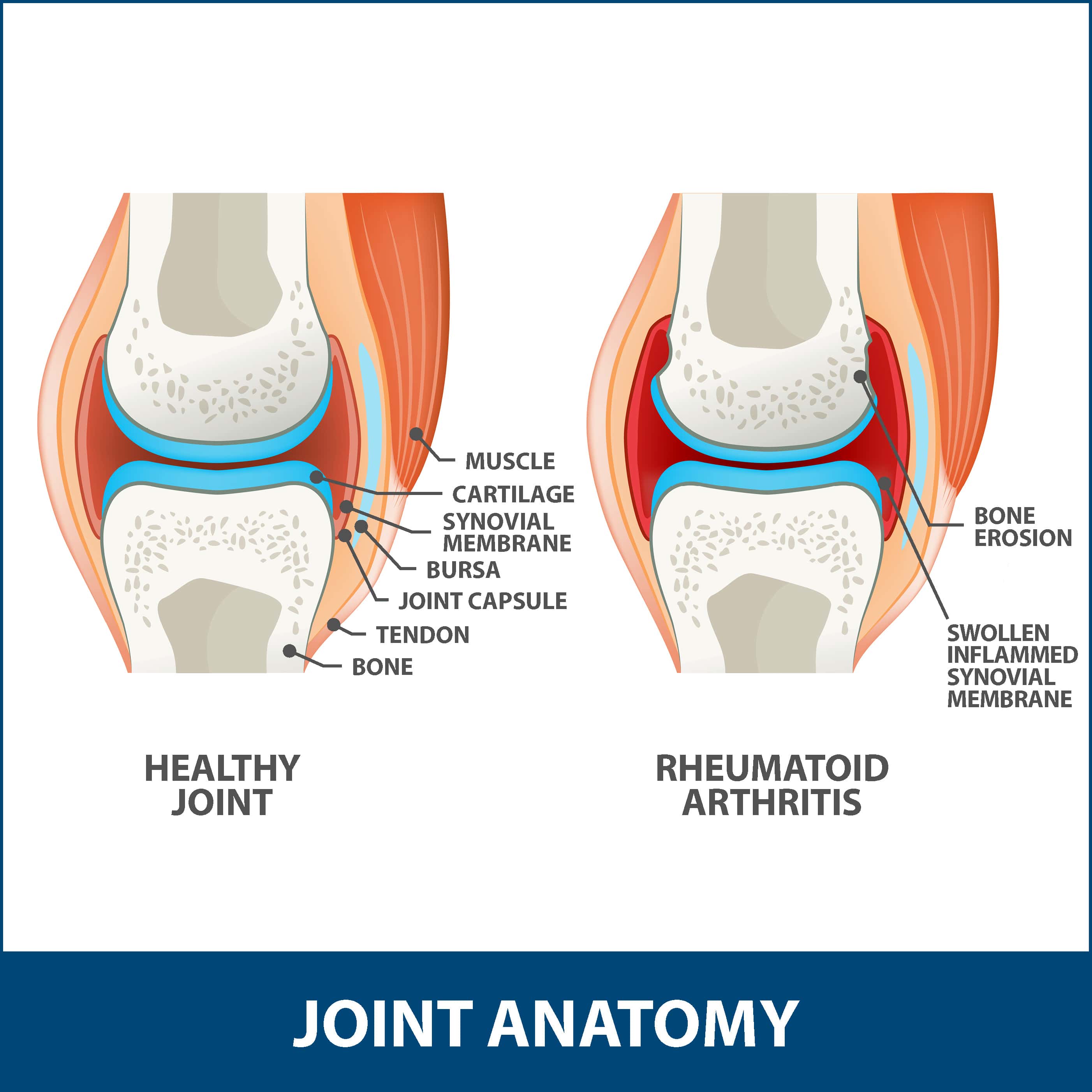 tratamentul osteofitelor coloanei lombare dureri la nivelul articulației cotului cu osteocondroză cervicală