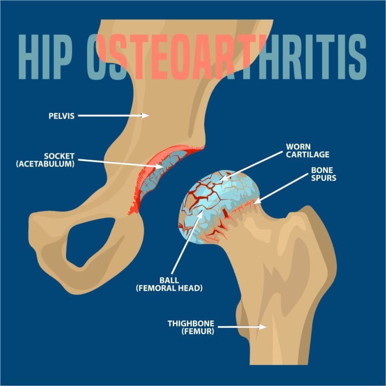 Osteoarthritis of the Hip | Florida Orthopaedic Institute
