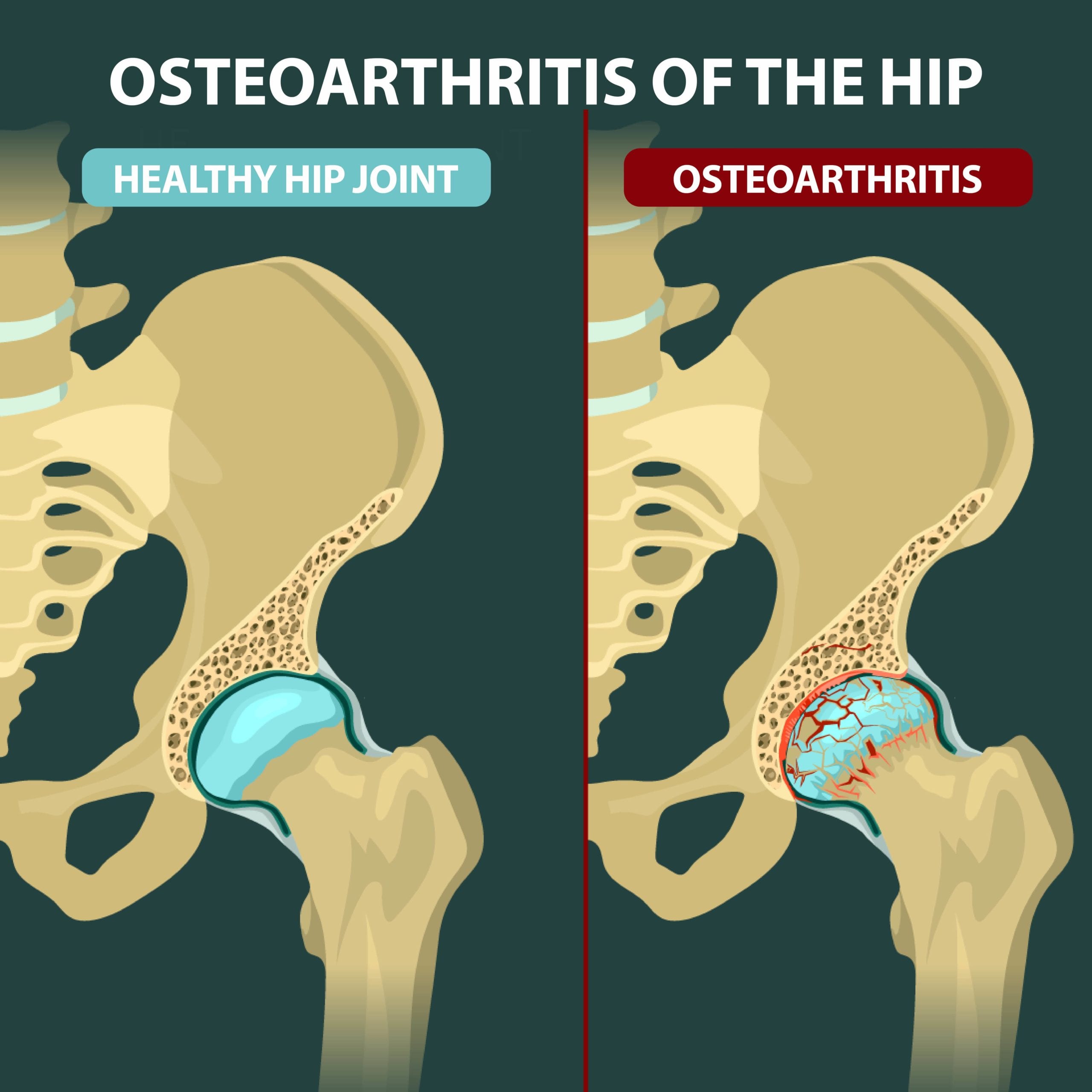 osteoarthritis symptoms hip)