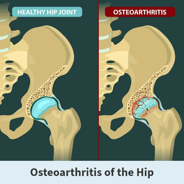 Osteoarthritis Of The Hip Florida Orthopaedic Institute