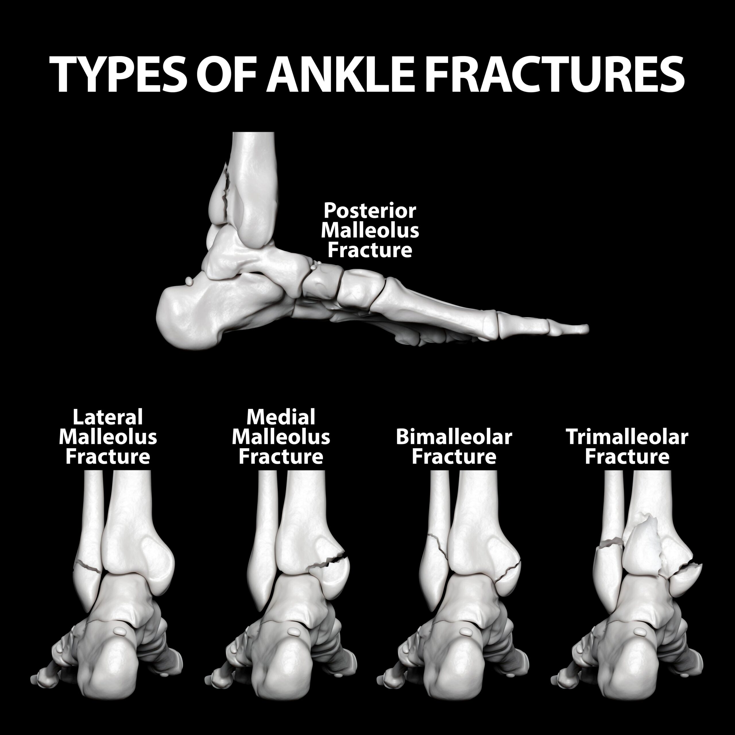 ankle fracture surgery
