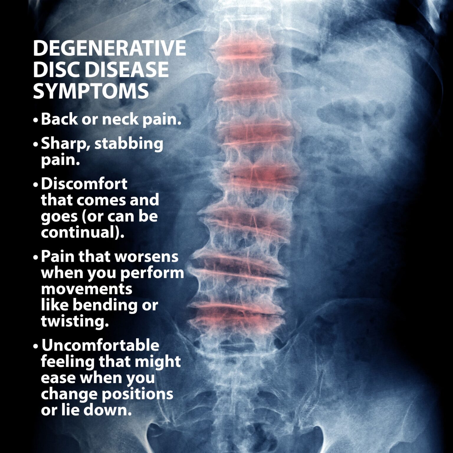 Degenerative Disc Disease Causes Symptoms Pictures And Treatment | My ...