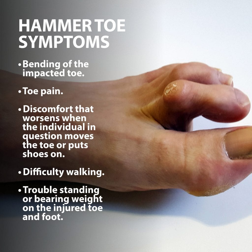 Hammer Toe & Toe Joints Florida Orthopaedic Institute