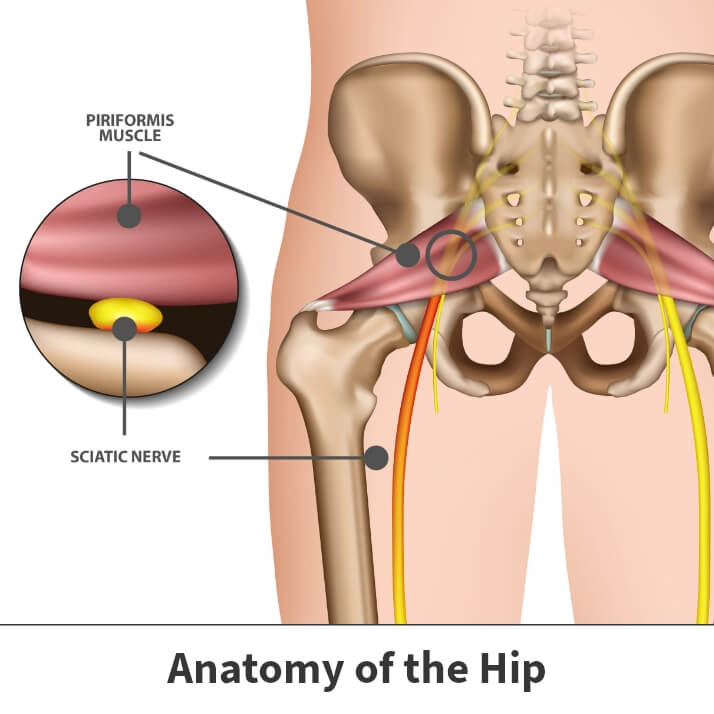 Piriformis Syndrome  Florida Orthopaedic Institute