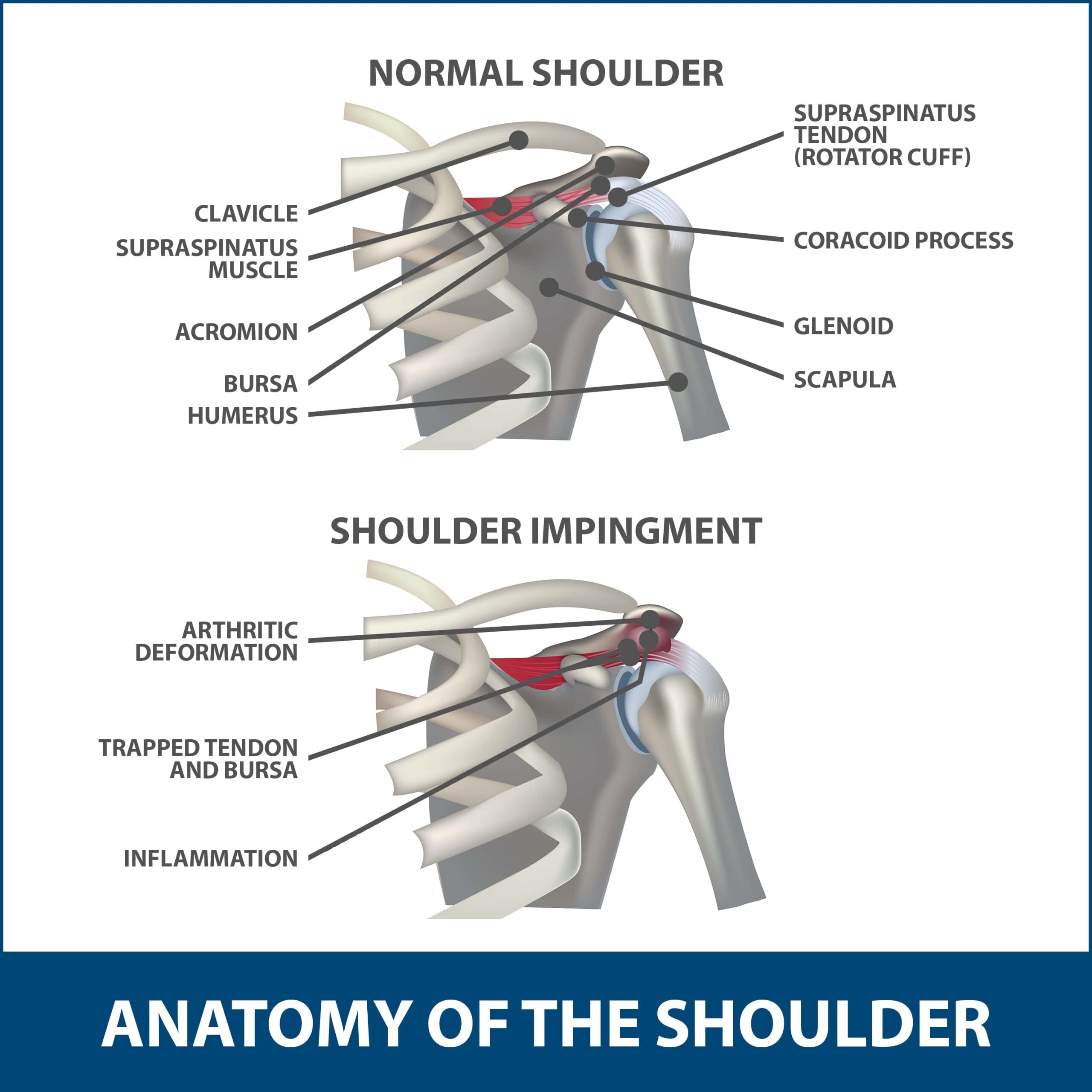 Impingement Syndrome of the Shoulder