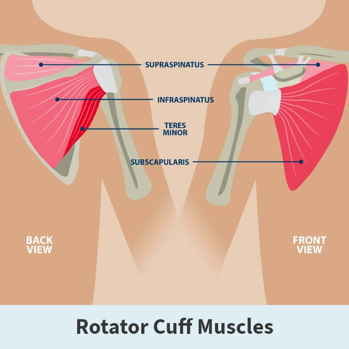 A) Massive rotator cuff tear. (B-E) Intra-articular arthroscopic view