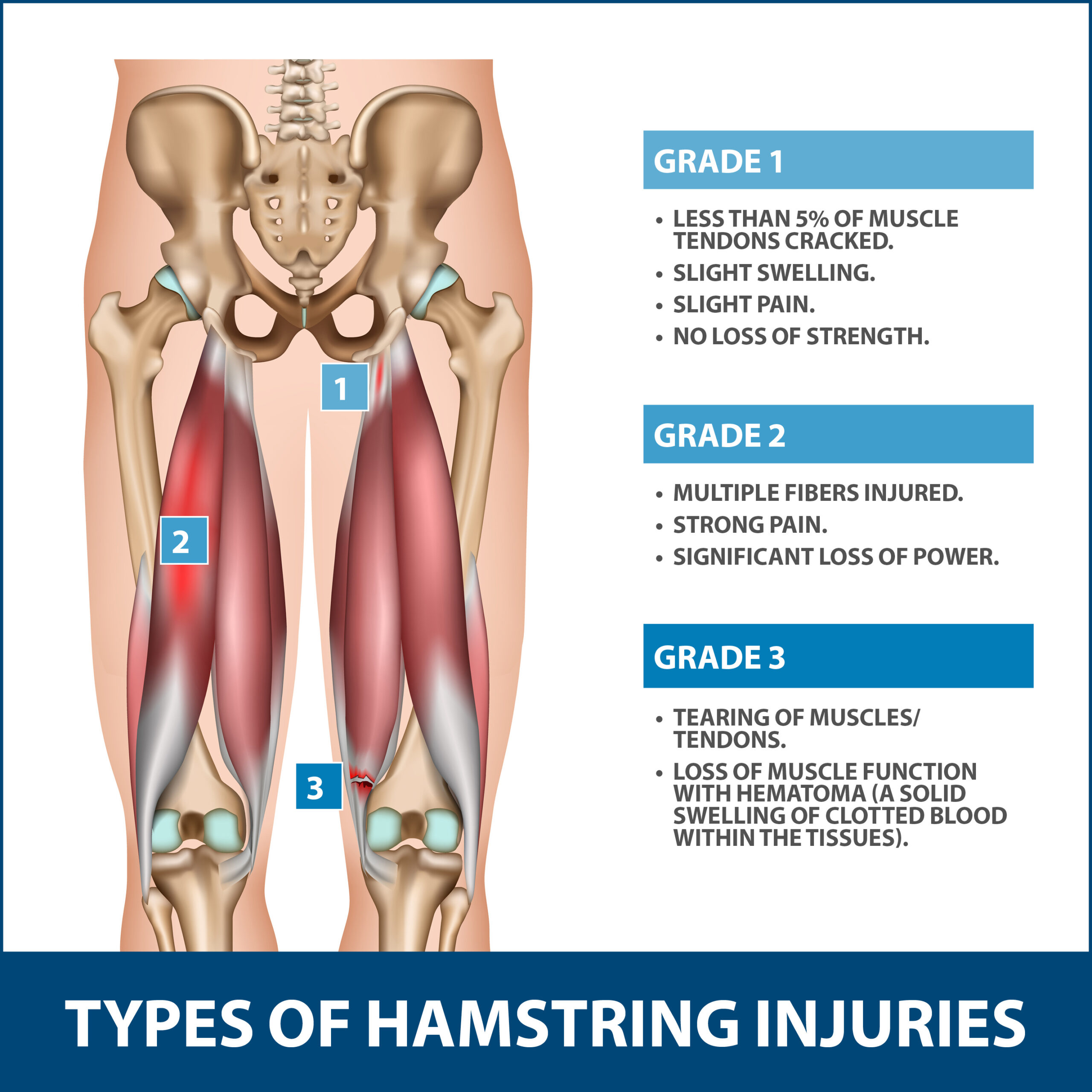 Hamstring Injuries