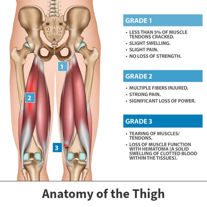 Hamstring Injuries