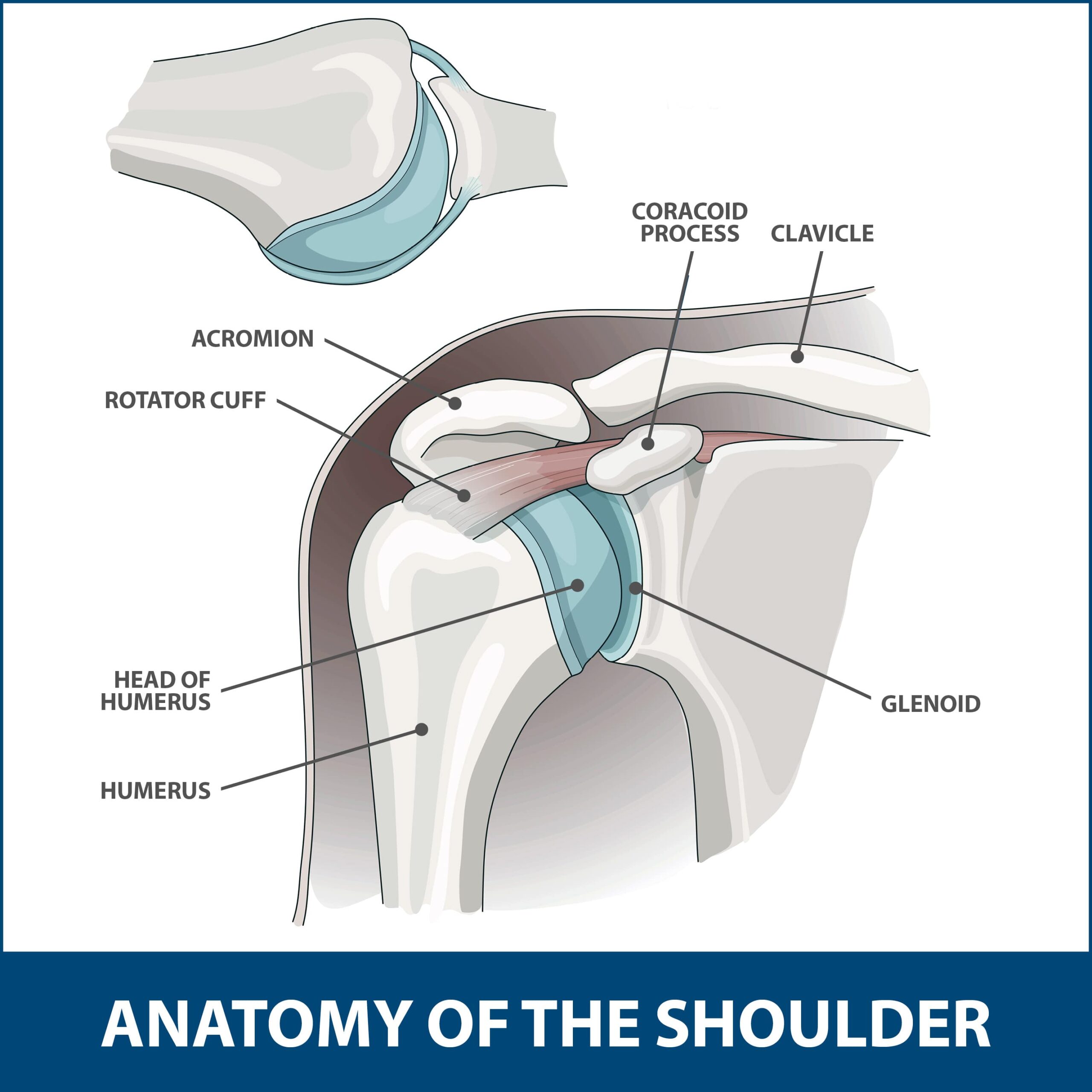 anatomy of the shoulder showing where the diseased shoulder might need shoulder impingement surgery