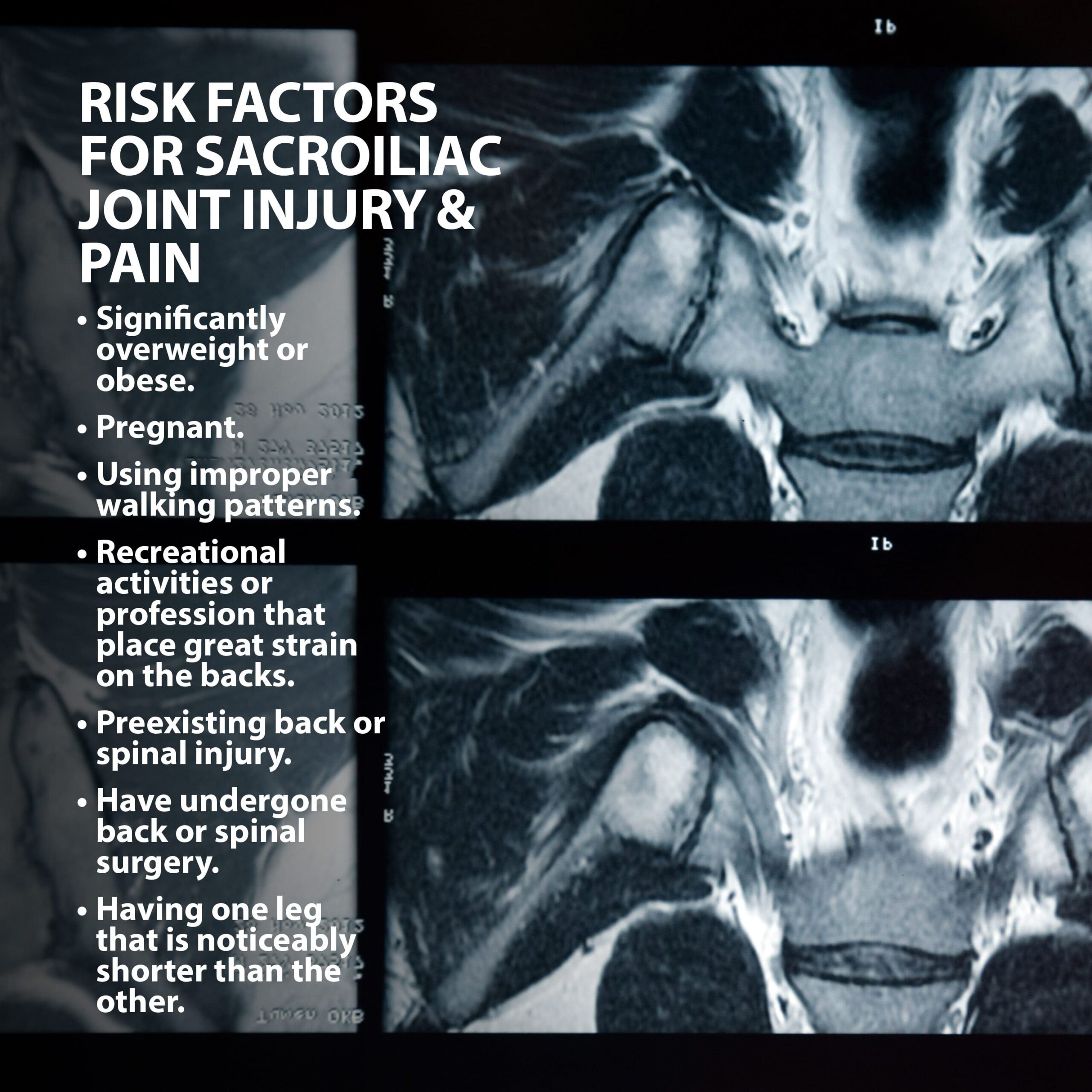 anatomy of the pelvis showing risk factors of Sacroiliac Joint Pain and how Sacroiliac Joint Pain Treatment can help