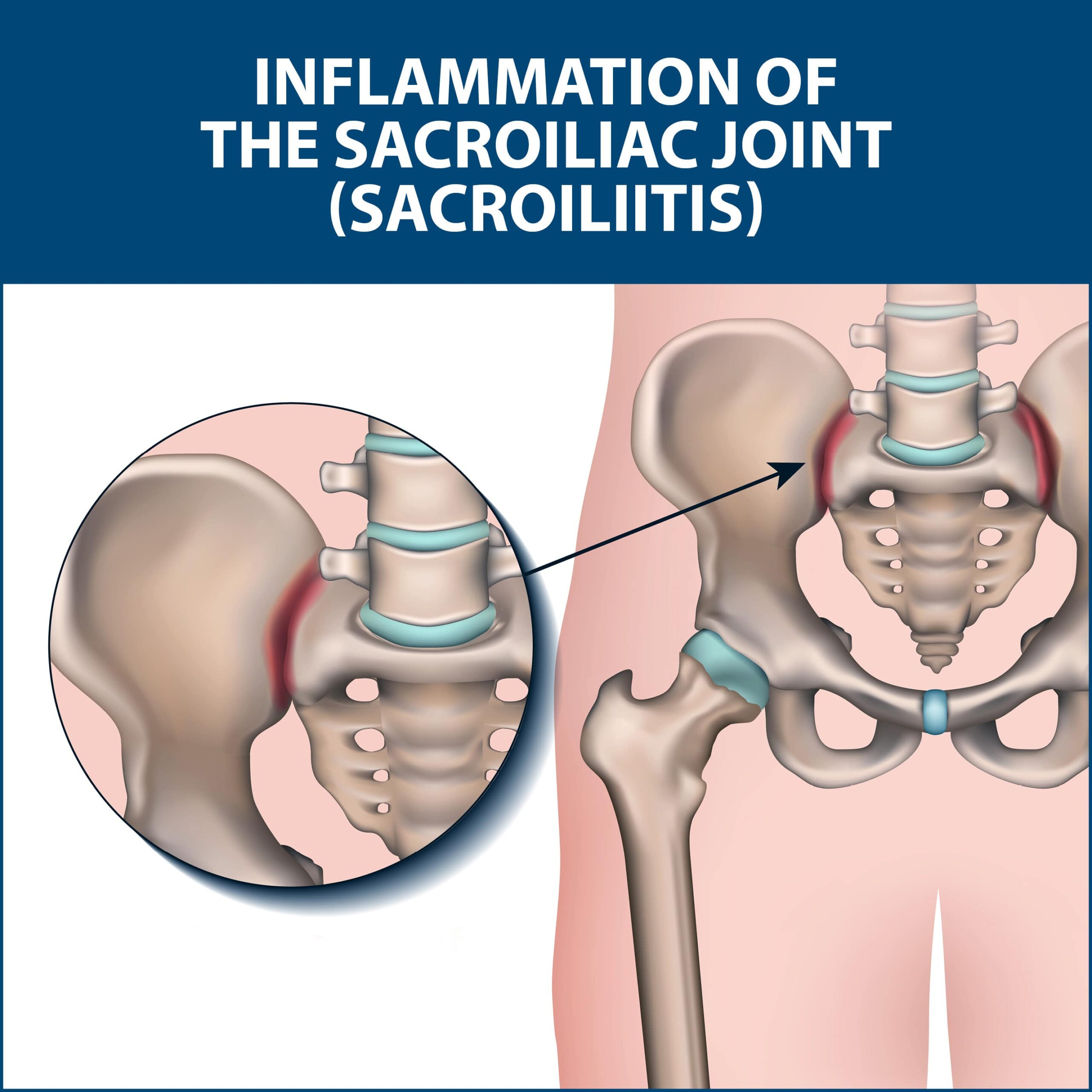anatomy of the pelvis showing where Sacroiliac Joint Pain Treatment can help inflammation of the SI joint