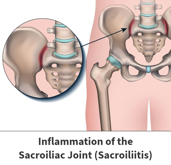 anatomy of the pelvis showing where Sacroiliac Joint Pain Treatment can help inflammation of the SI joint