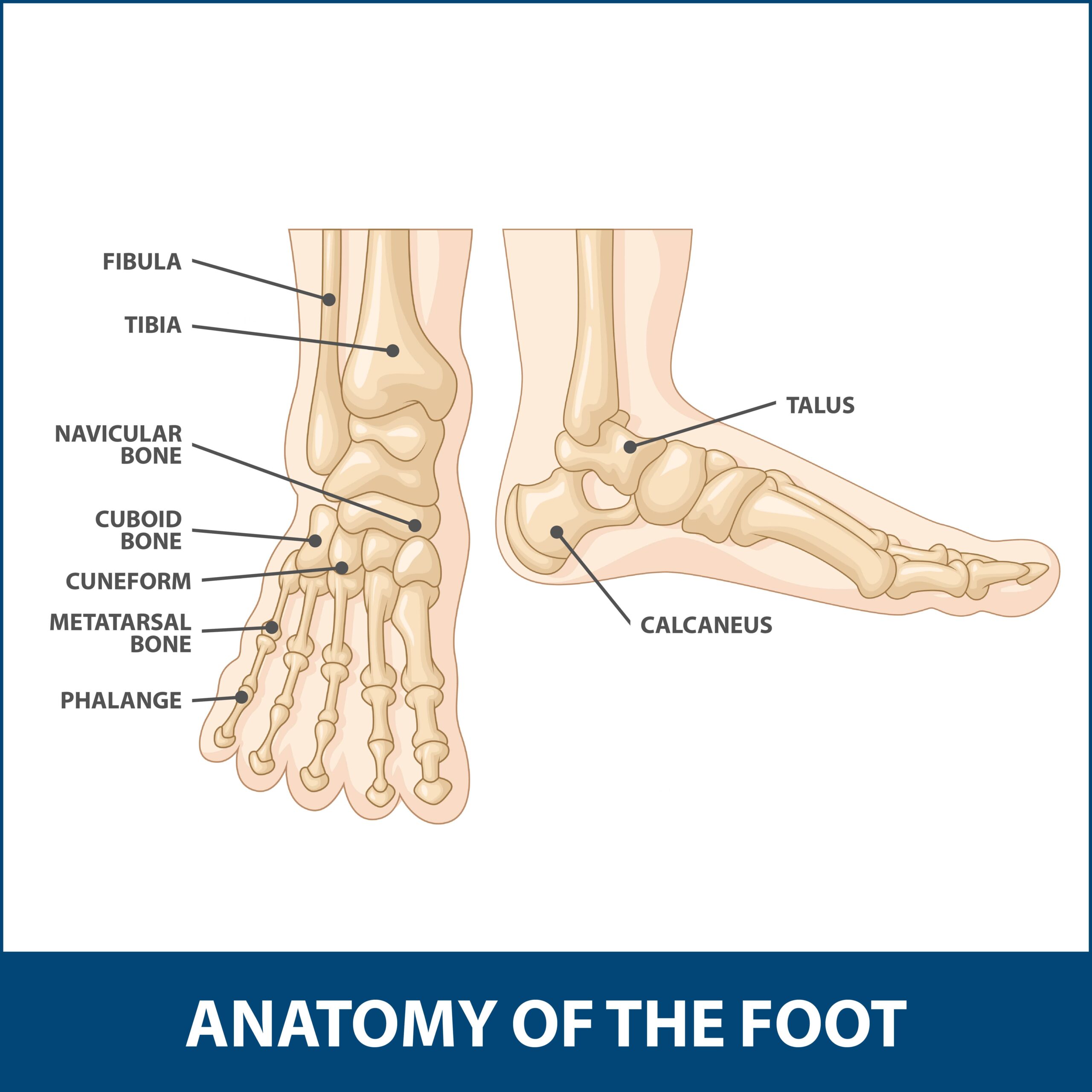 Calcaneal Fracture ORIF - FootEducation