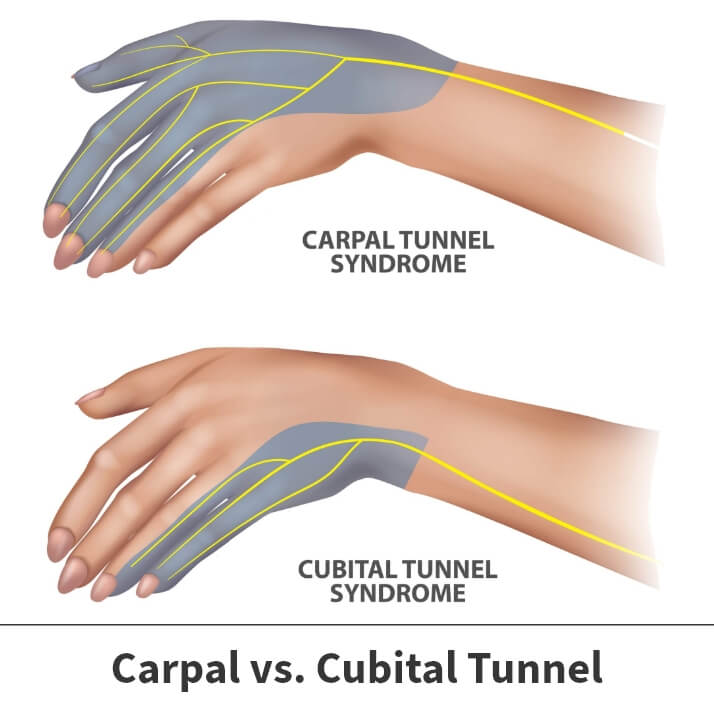 Cubital Tunnel Syndrome Info  Florida Orthopaedic Institute