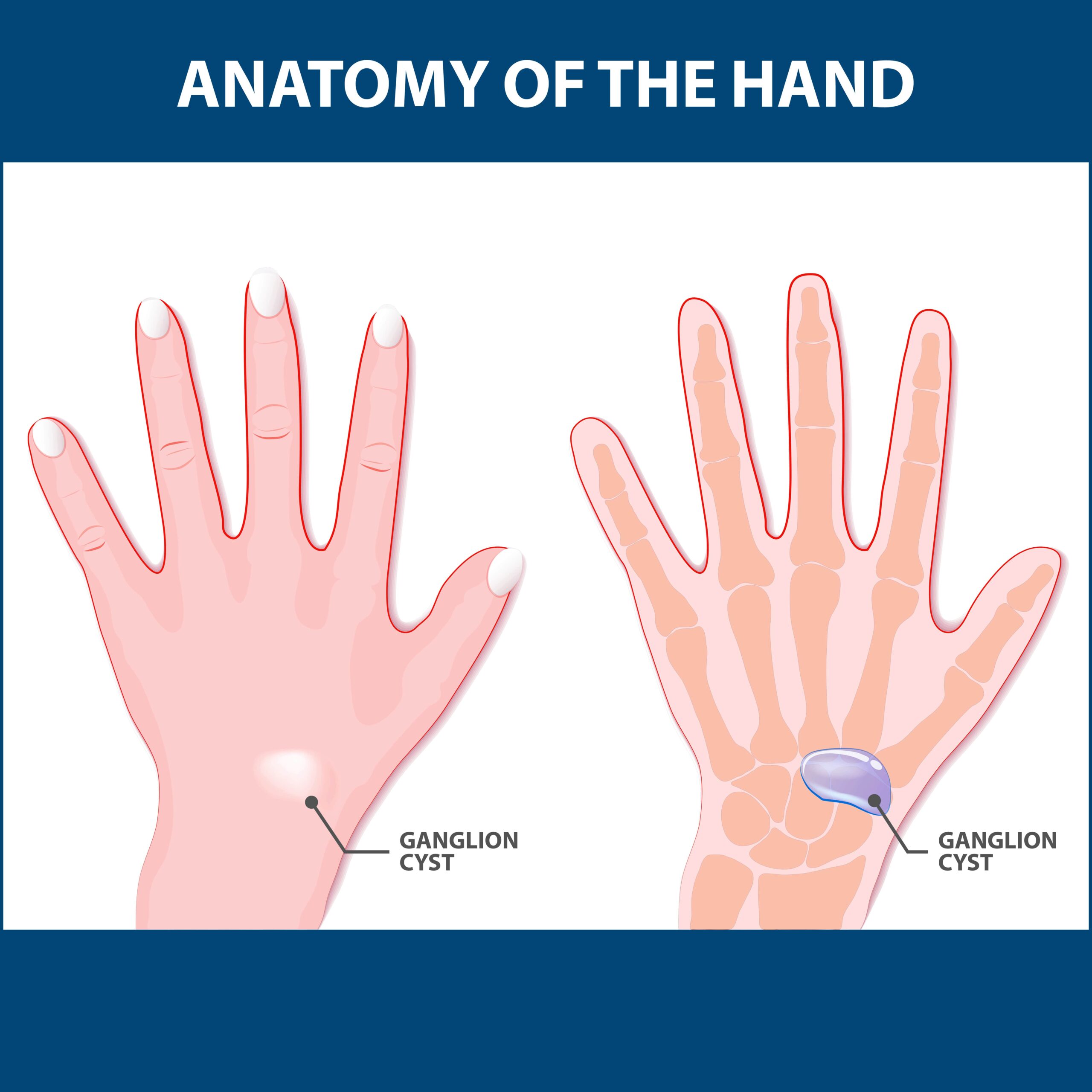 Ganglion Cyst Wrist Treatment Florida Orthopaedic Institute