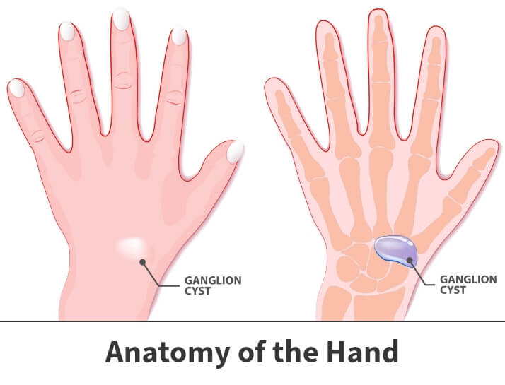 Ganglion Cyst wrist treatment