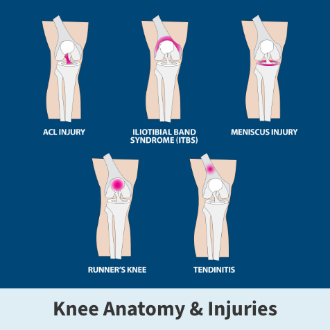 Diagram of knee anatomy and injuries including acl injuries, ITBS, meniscus injury, runner's knee, and tendonitis