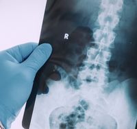 physician holding x-ray of spine